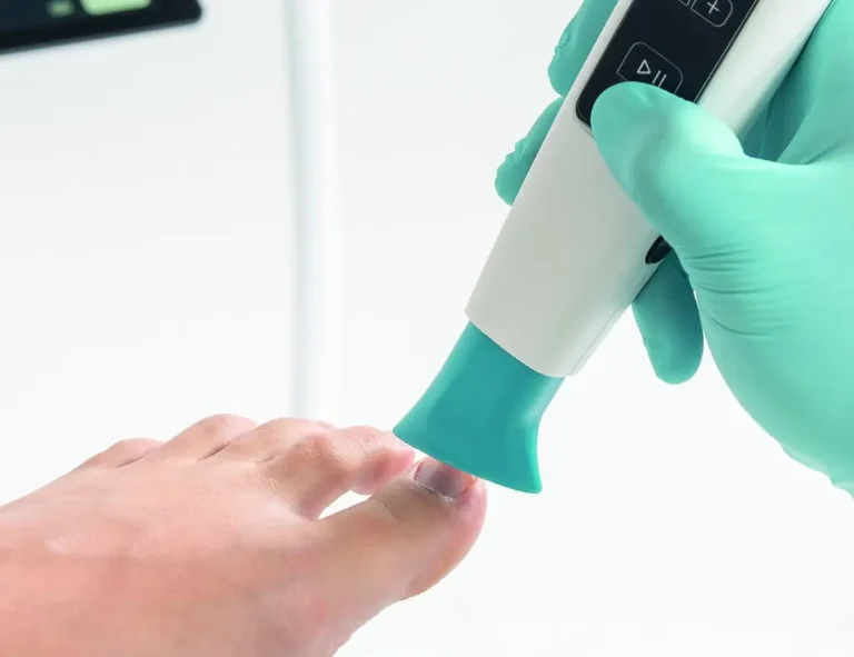 Fungal nail treatment with RUCK ViroCap cold plasma at Pedicare